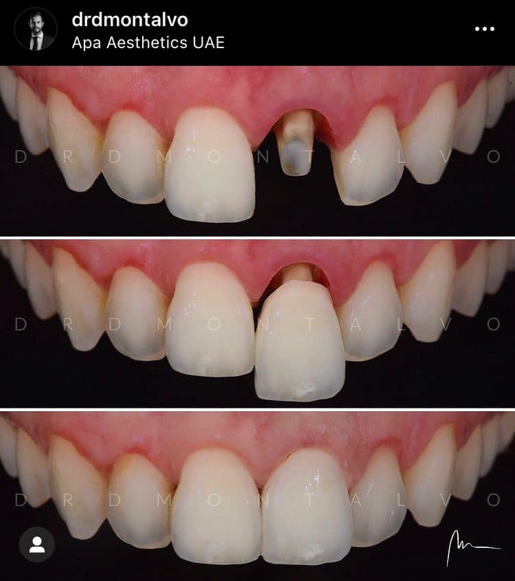 Couronne dentaire : votre dent de substitut, collée sur un reste de dent